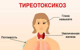 Тиреотоксикоз: симптомы и лечение щитовидной железы, у женщин