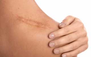 Методы выведения шрамов от порезов