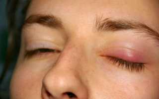 Воспаление верхнего и нижнего века глаза – лечение