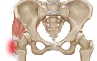Воспаление и повреждения связок тазобедренного сустава