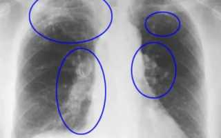 Что такое пневмосклероз легких – как его лечить, симптомы и признаки