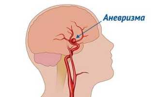 Причины аневризма сосудов головного мозга и ее последствия