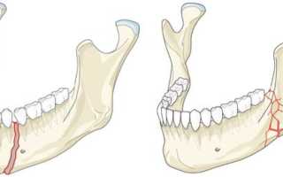 Симптомы и лечение перелома нижней челюсти