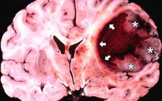 Прогнозы жизни при диагнозе глиобластома мозга