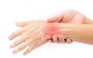 Симптомы и лечение разрыва связочного аппарата кисти руки
