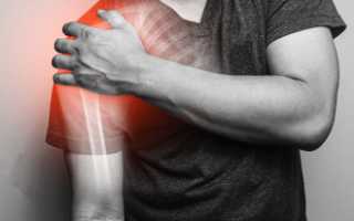 Лечение перелома плеча со смещением и реабилитационный период