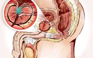 Причины, симптомы и лечение конгестивного простатита у мужчин