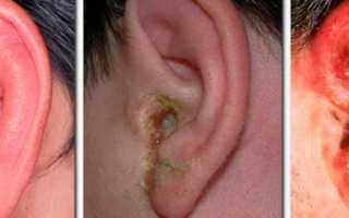 Отит среднего уха – симптомы и лечение у ребенка и взрослого
