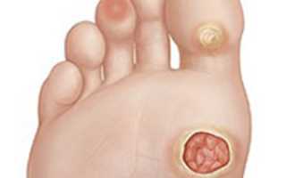 Лечение незаживающих ран на ногах при сахарном диабете