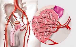 Показания и противопоказания к эмболизации артерий простаты