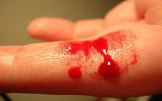 Как остановить кровотечение при геморрое в домашних условиях