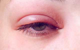 Воспаление глаза — лечение покраснения каплями