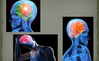 Закрытая черепно-мозговая травма (ЗЧМТ)